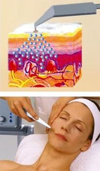 Vakuový masážní stroj VACUUM II